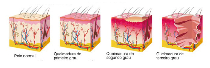 Queimadura-Guia2